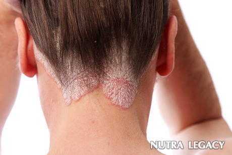 Vitiligo Vitiligo