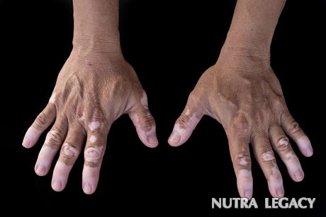 5 Facts about Vitiligo 5 Facts about Vitiligo