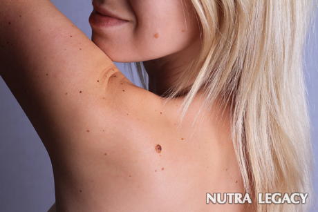 7 Facts about Birthmarks 7 Facts about Birthmarks