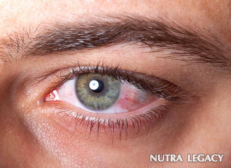 A Guide To Subconjunctival Hemorrhage A Guide To Subconjunctival Hemorrhage