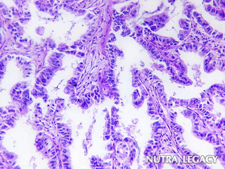 Adenocarcinoma Cancer Adenocarcinoma Cancer