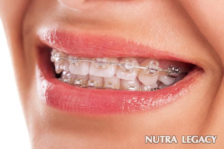 Adult Orthodontia Adult Orthodontia