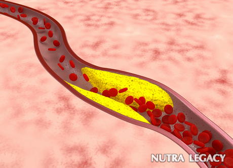 Hardening of Arteries