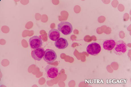 Sarcoma Sarcoma