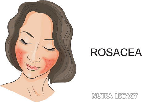 Blood Vessels And Rosacea - 5 Of The Most Effective Rosacea Remedies Blood Vessels And Rosacea - 5 Of The Most Effective Rosacea Remedies