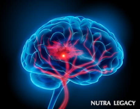 Brain Hemorrhage Brain Hemorrhage