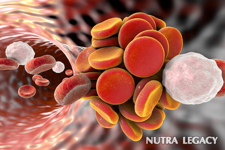Deep Vein Thrombosis Deep Vein Thrombosis