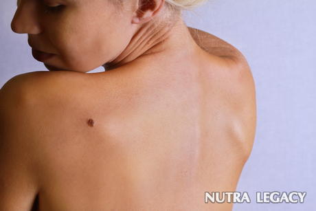Types of Moles Types of Moles