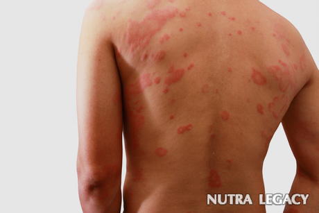 Eczema Treatment Eczema Treatment