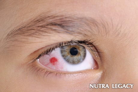 Eye Blood Vessel Popped Eye Blood Vessel Popped
