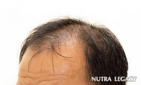 hair-loss