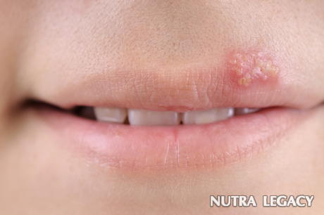 herpes herpes