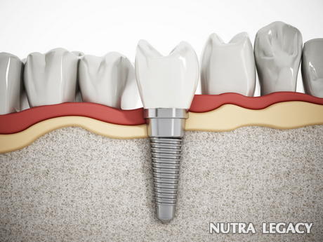 How Dental Implants Work