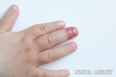 Bacterial Skin Infections
