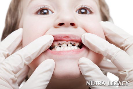 Tooth Decay In Children Tooth Decay In Children