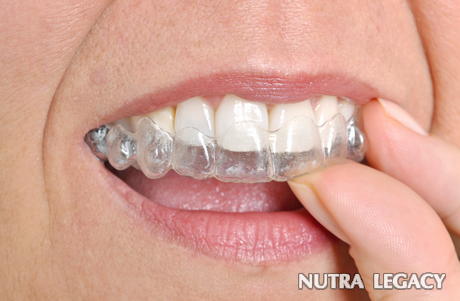 Invisalign Vs Invisalign Vs