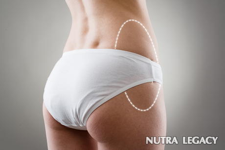 Large Volume Liposuction Large Volume Liposuction