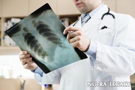 Mesothelioma Asbestos Lung Cancer Mesothelioma Asbestos Lung Cancer