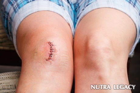 Natural Scar Treatment Natural Scar Treatment