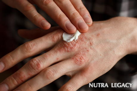 Psoriasis Treatment Psoriasis Treatment