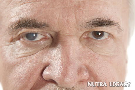 Iritis Iritis