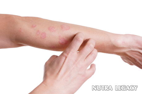 Skin Disorders