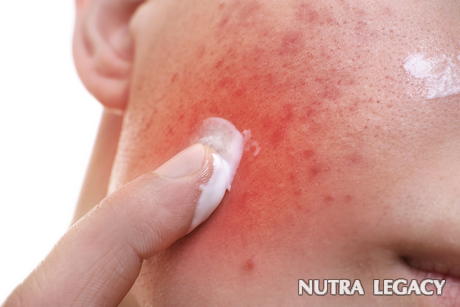Skin Redness Skin Redness