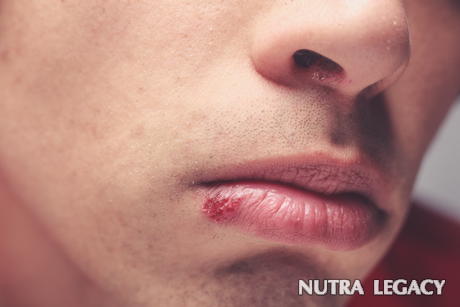Herpes Mouth Herpes Mouth