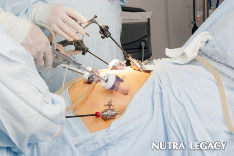 Risks Of Gastric Bypass Surgery Risks Of Gastric Bypass Surgery