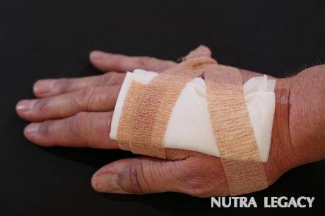wound-healing wound-healing